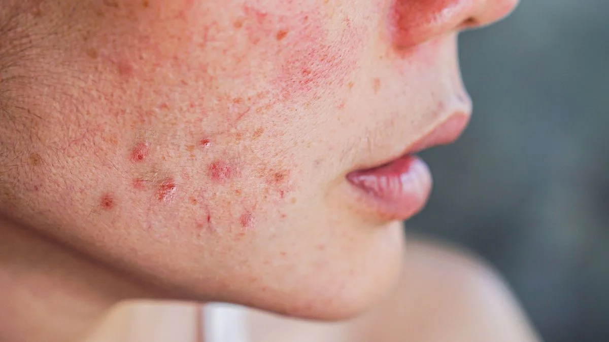 Como reduzir manchas de acne no rosto
